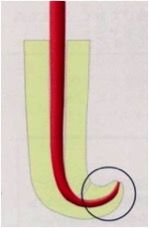 ②根管洗浄、③根管貼薬