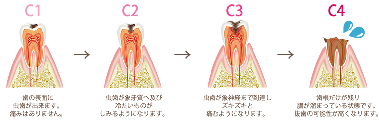 むし歯の進行について