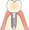 インプラント