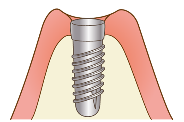 一次手術（インプラント埋入）
