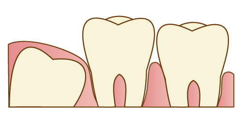 親知らずは抜いたほうがいい？