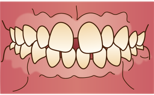 すきっ歯を治したい