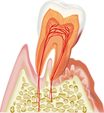 歯周炎（重度）
