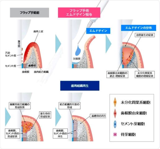 エムドゲインを使用した歯周組織再生療法