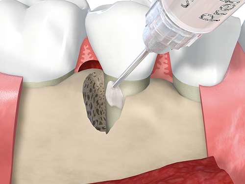 エムドゲインを使用した歯周組織再生療法